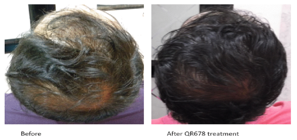 Best Hair Treatment in Mumbai, India | Best Hair Clinic in India | Hair  Specialist Doctor in Mumbai |Hair Treatment Mumbai