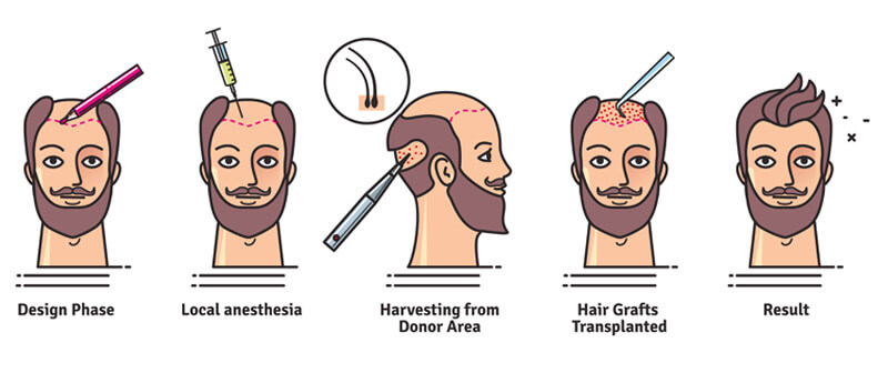 Hair Transplant in Mumbai, India at Affordable cost by Dr Debraj Shome at The Esthetic Clinics